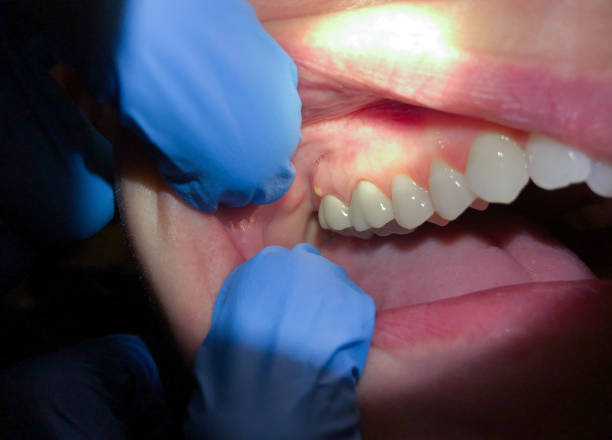 Best Emergency Care for Gum Disease in Broad Brook, CT